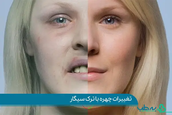 تغییرات چهره، عوارض ترک سیگار|به طب آنلاین