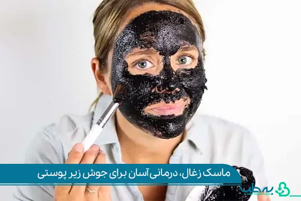 درمان جوش زیر پوستی با ماسک زغال|به طب آنلاین
