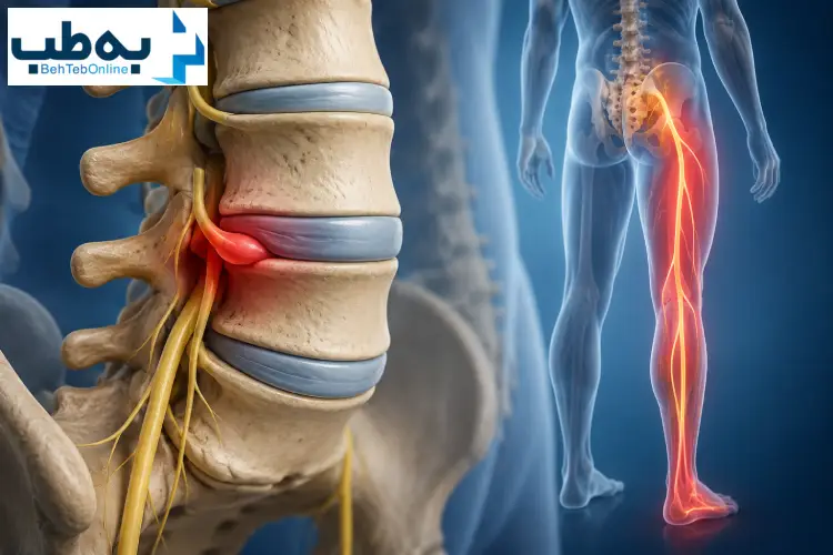 تفاوت دیسک کمر و سیاتیک