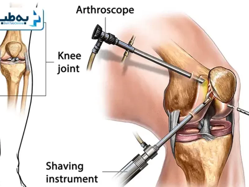 جراحی مینیسک زانو با روش آرتروسکوپی - آرتروسکوپی زانو چیست؟
